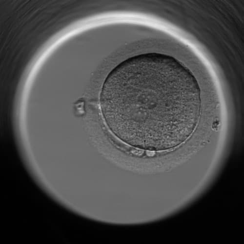 Einzelner Embryotransfer nach 40